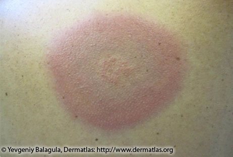 lyme disease rash